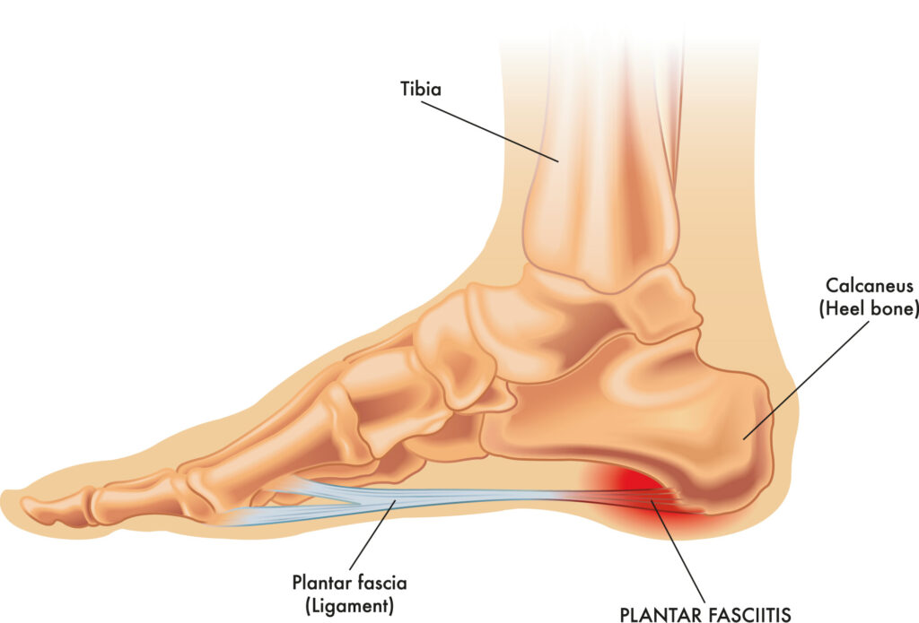 Fascitis plantar: síntomas, tratamiento y ejercicios
