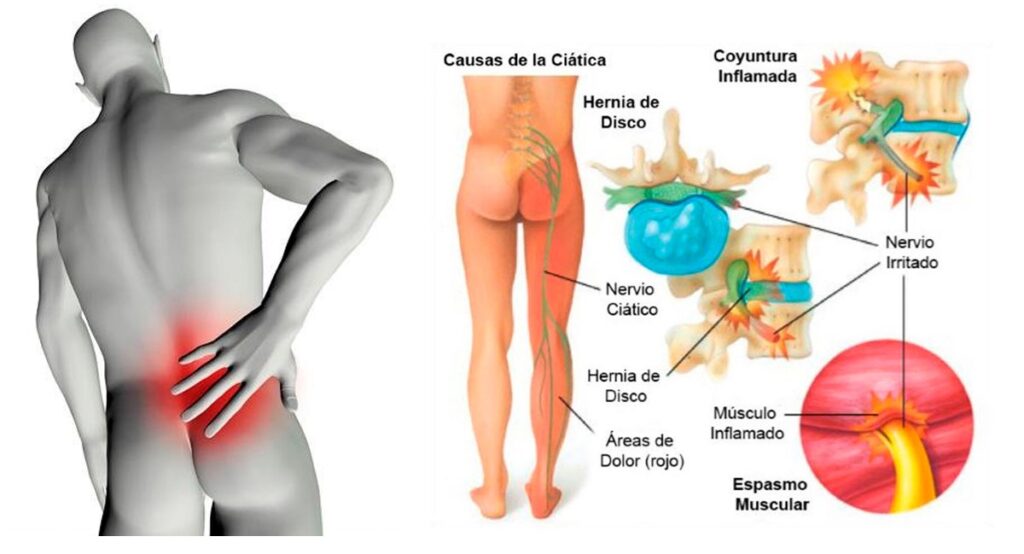 Dolor lumbar: causas, síntomas y tratamiento | LR Fisioterapia